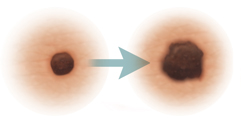 Skin lesions showing evolution of skin cancer.